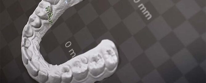 Digital vs Analog Orthodontics