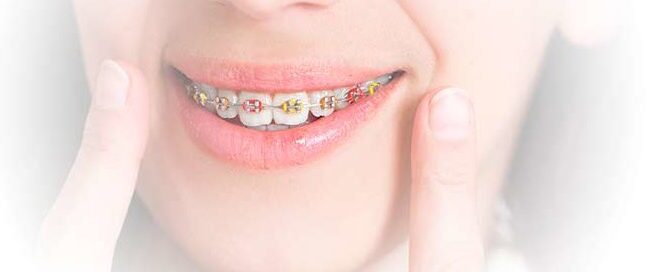 Self Ligating Brackets