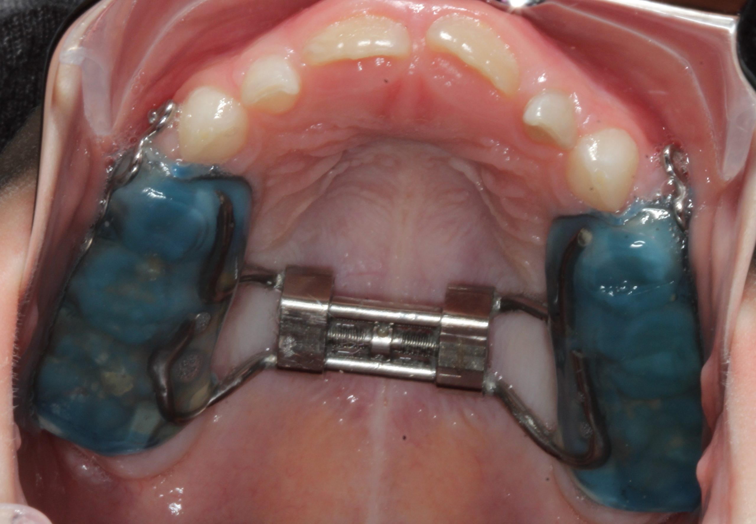 Palatal Expanders: Why, How, and When - Orthodontist Vaughan
