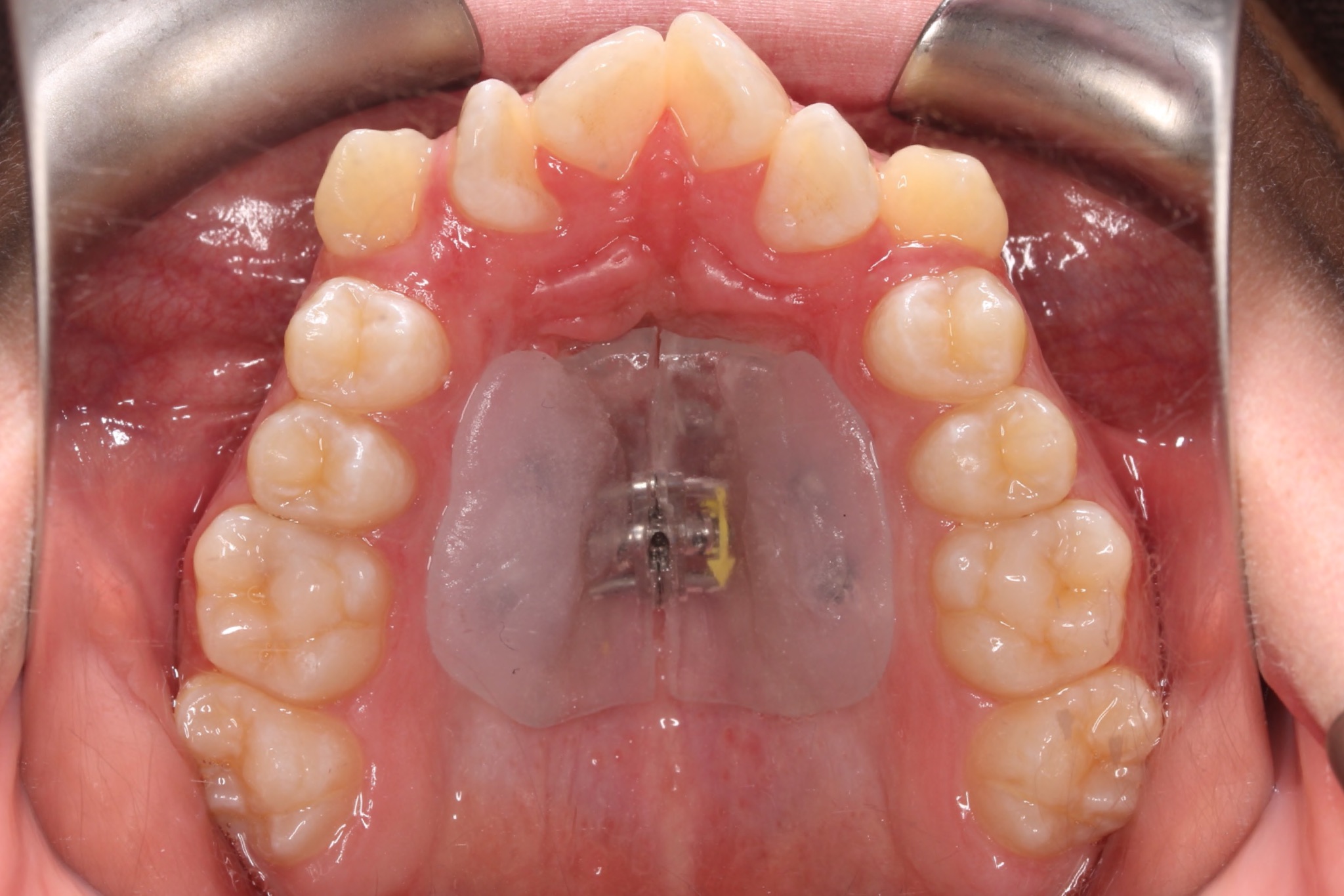 Palatal Expanders: Why, How, and When - Orthodontist Vaughan