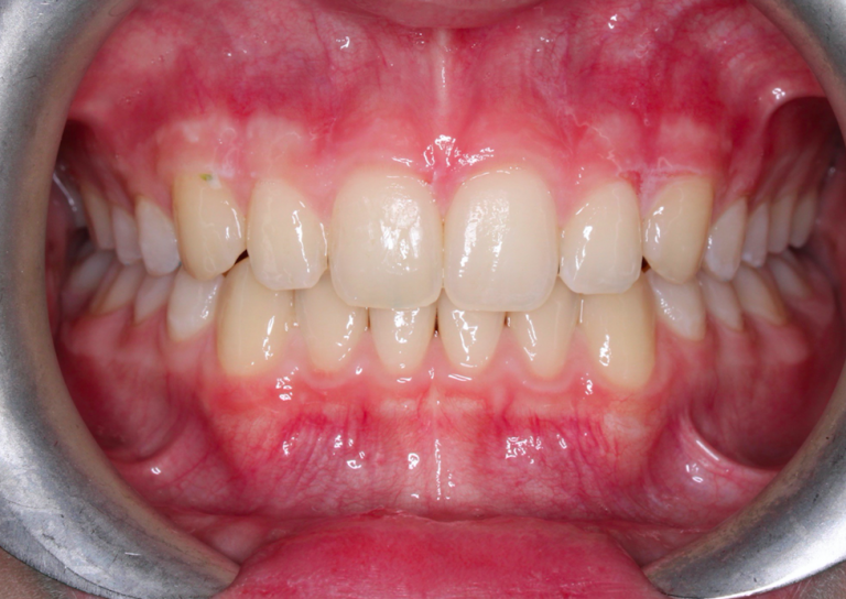 Gum Recession in Orthodontics Black Triangles