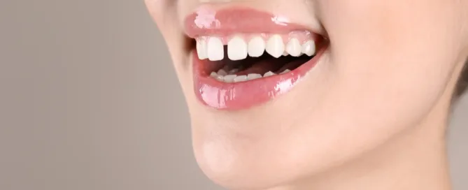 Can_You_Get_Braces_for_Just_Two_Teeth_
