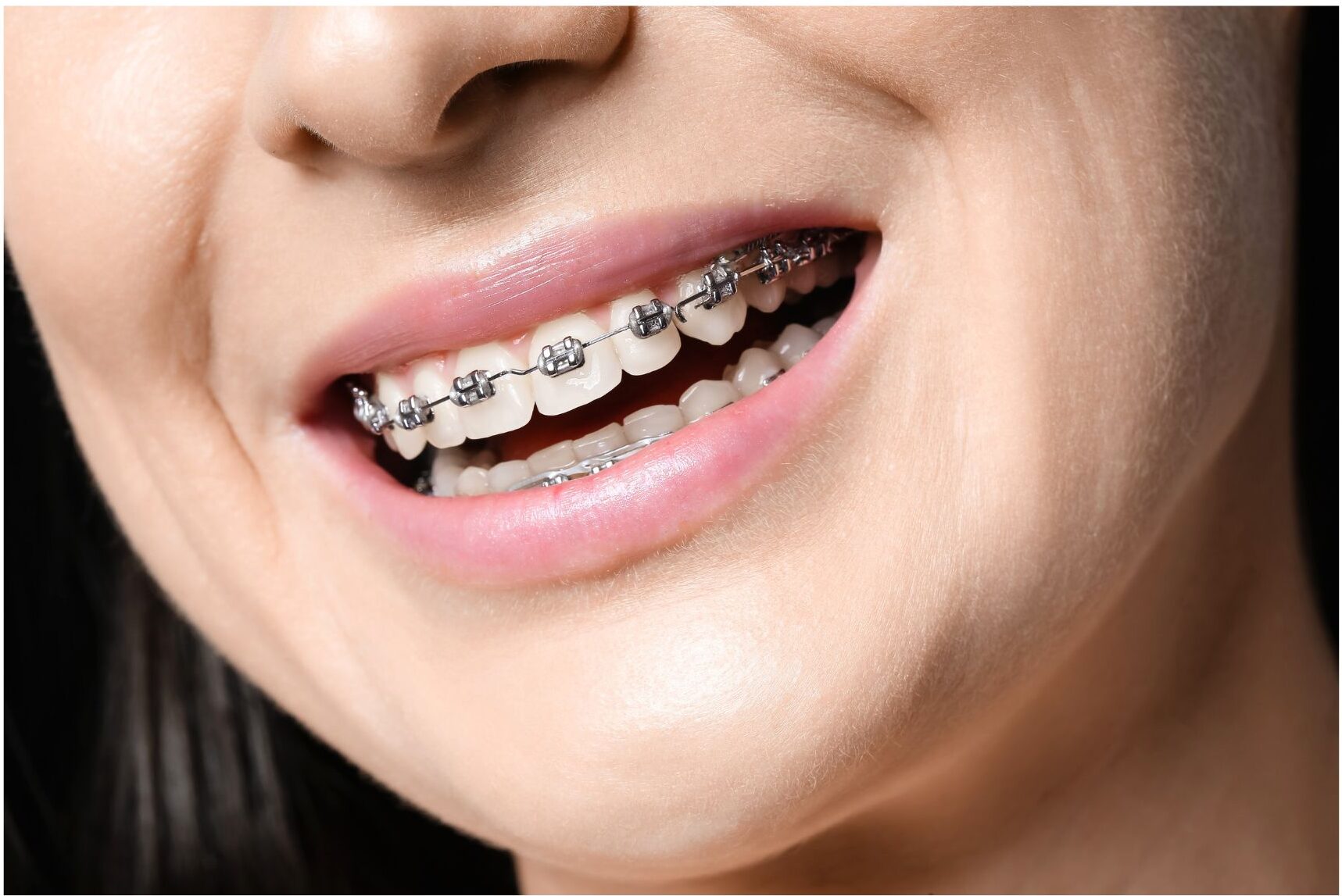 The Journey of Adult Orthodontics: What Late Starters Need To Know