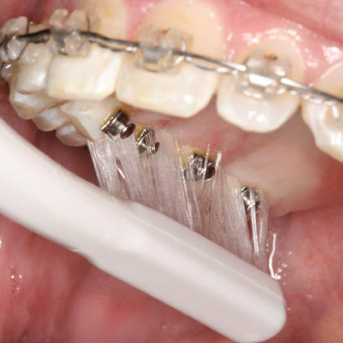 Additional Care Information For Braces | Walt Orthodontics