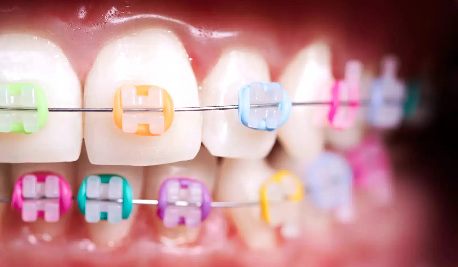 Why Don’t All Orthodontists Offer LightForce Braces?