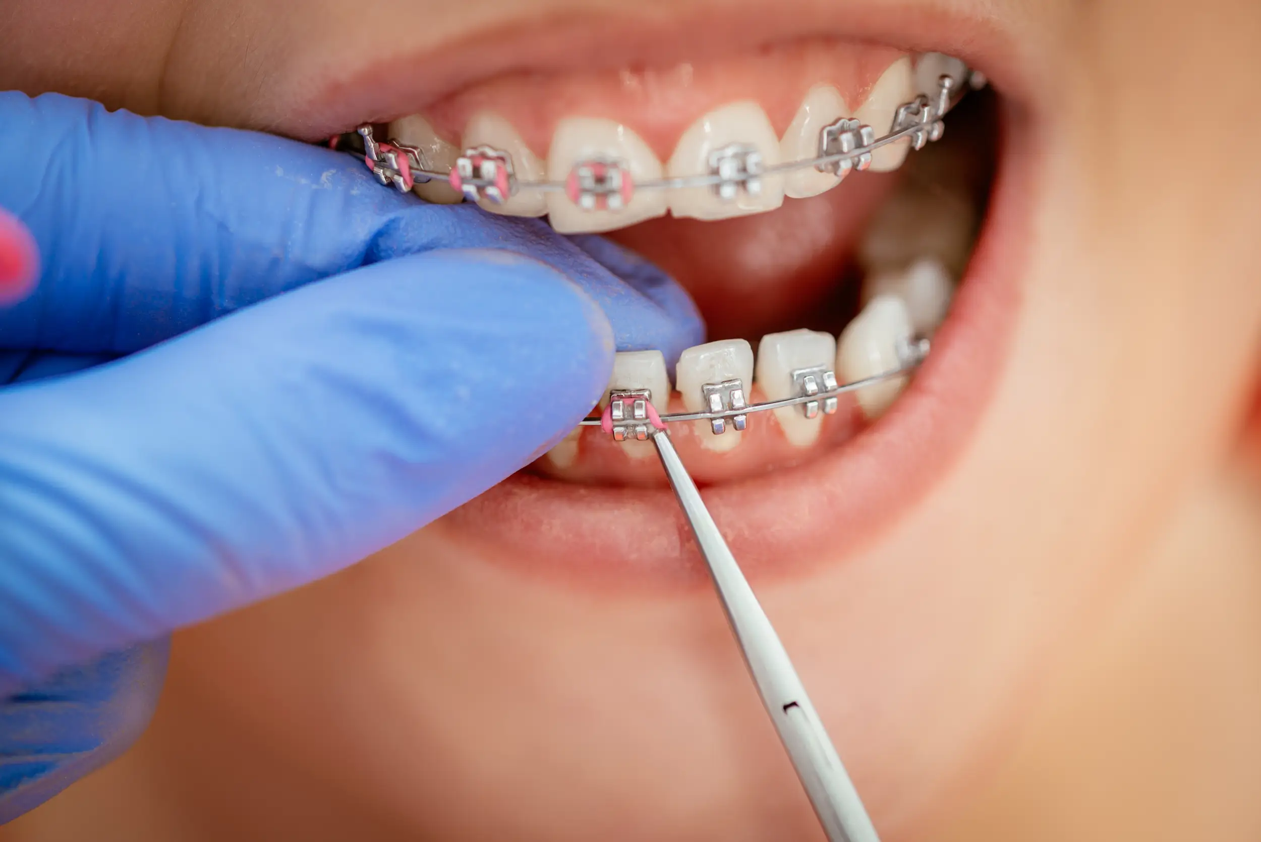 Can Braces Fix Gaps In Teeth?