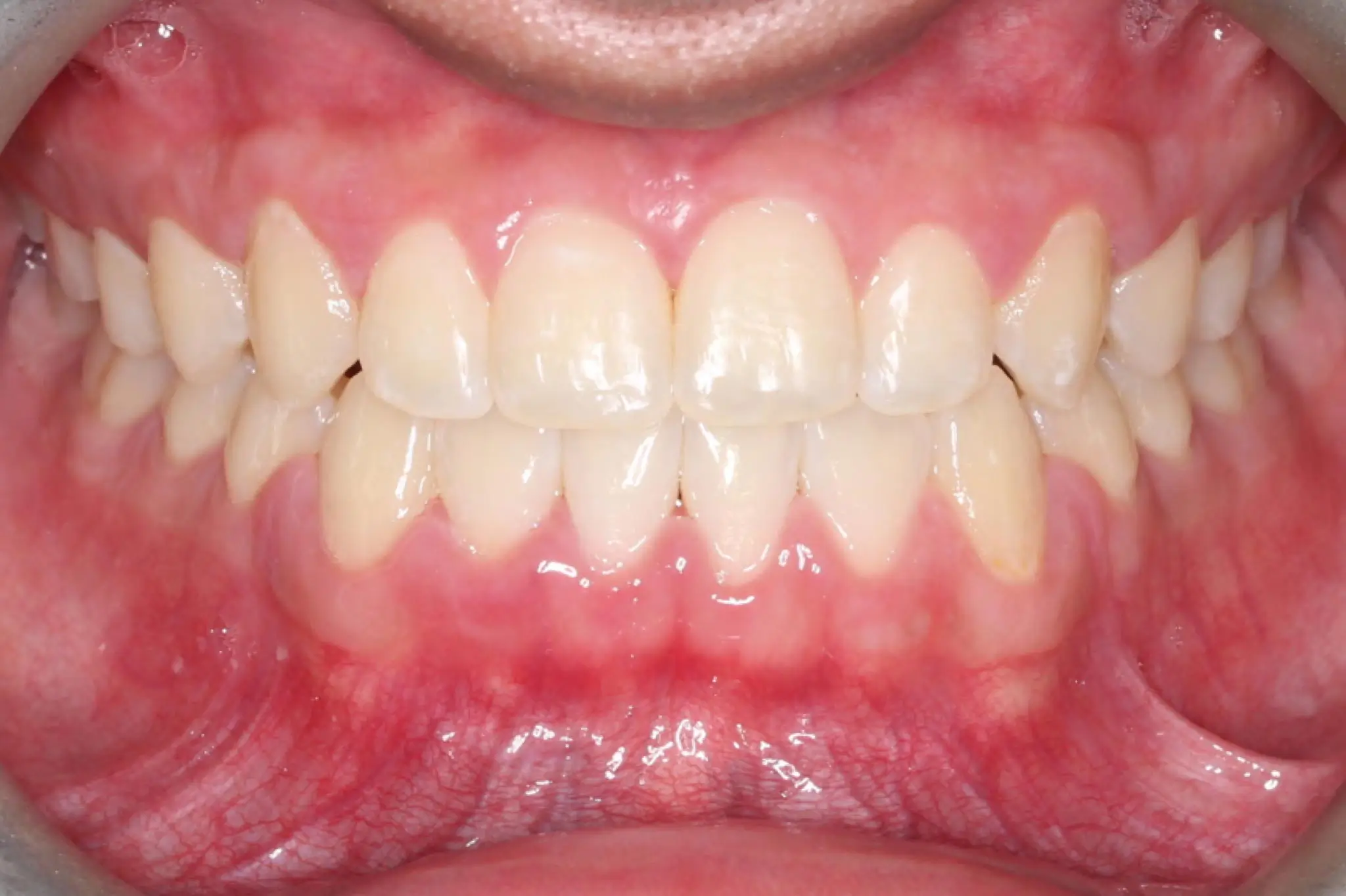 After Intraoral Centre Tooth Photo