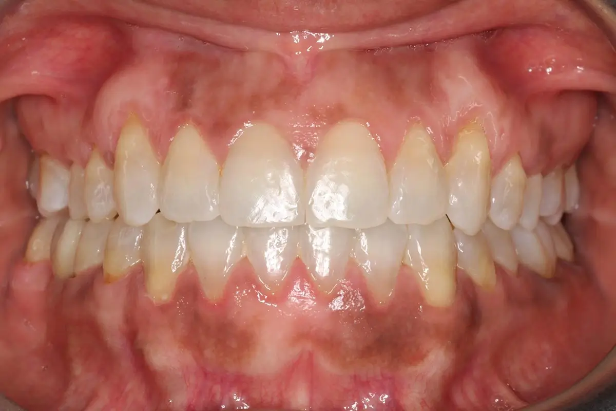After Intraoral Centre Tooth Photo