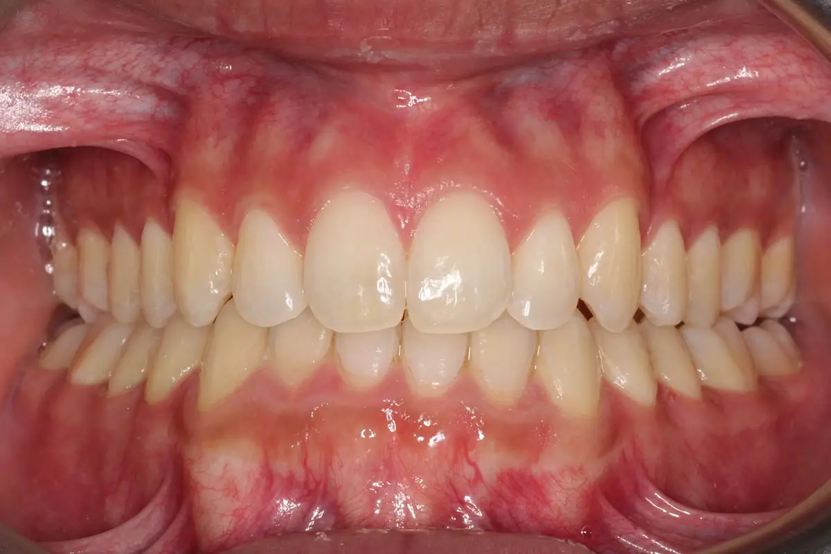 After Intraoral Centre Tooth Photo