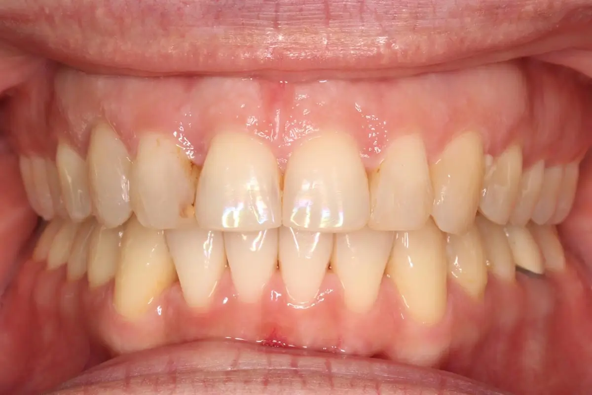 After Intraoral Centre Tooth Photo