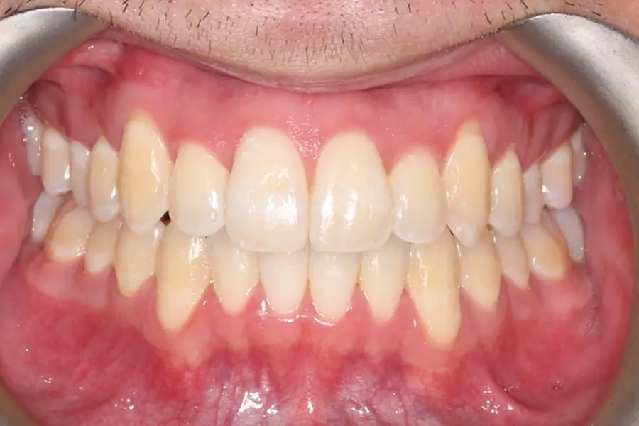 After Intraoral Centre Tooth Photo
