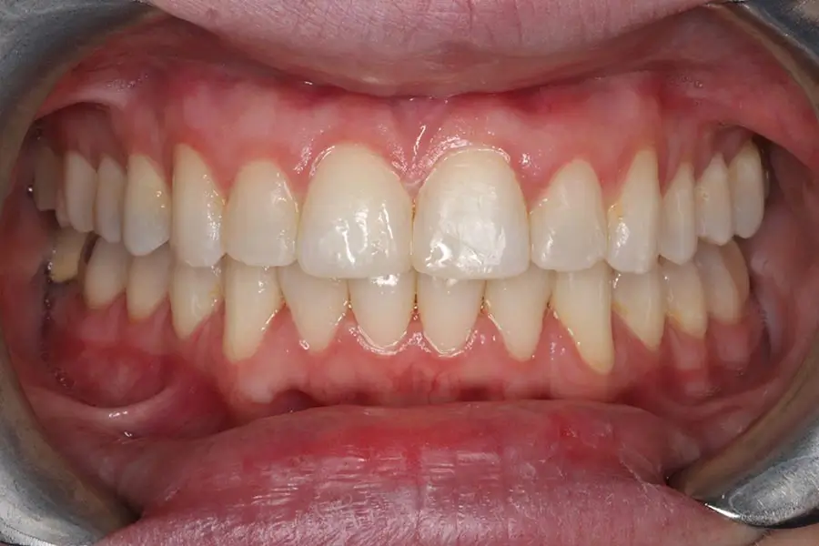 After Intraoral Centre Tooth Photo