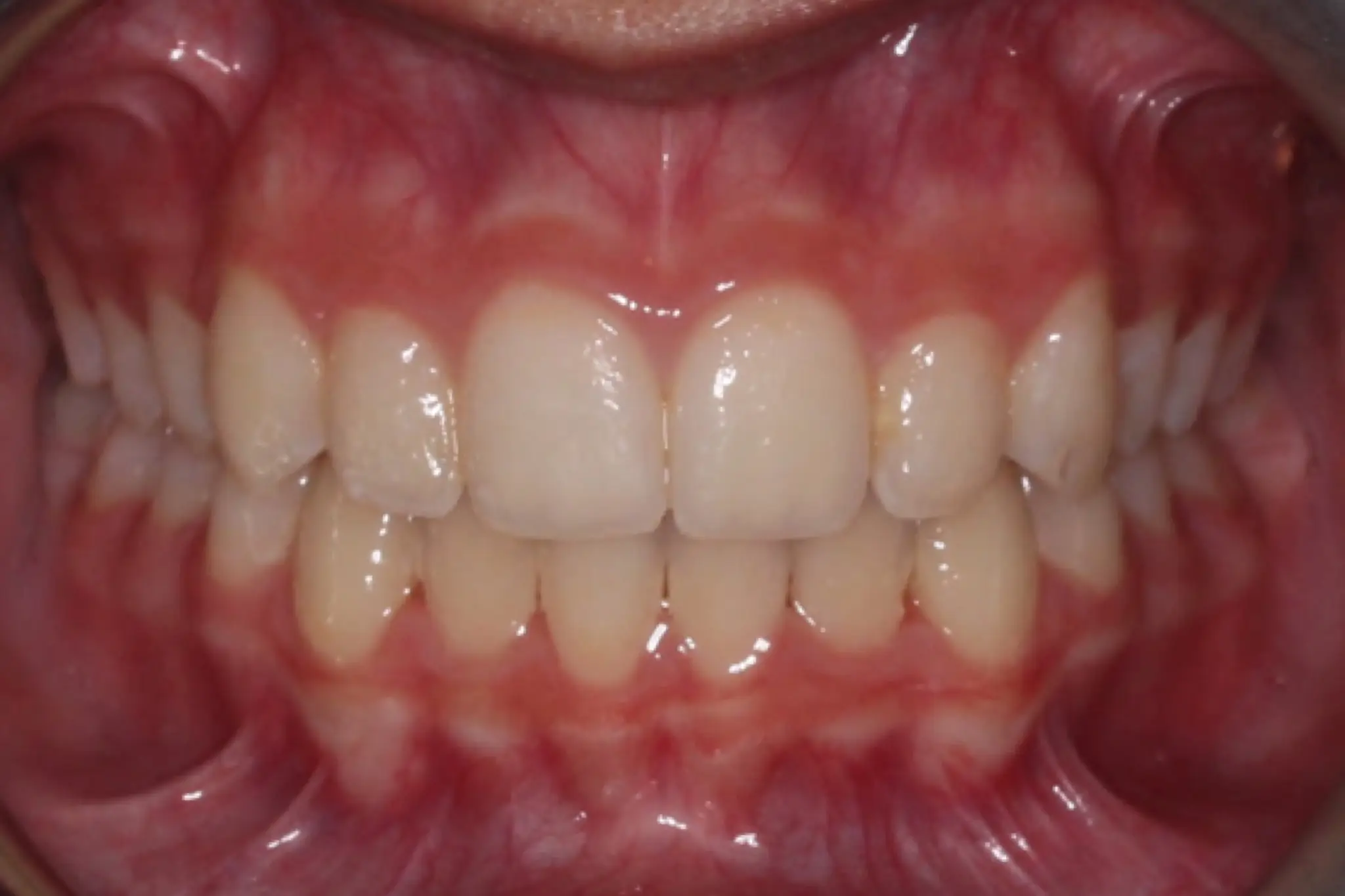 After Intraoral Centre Tooth Photo