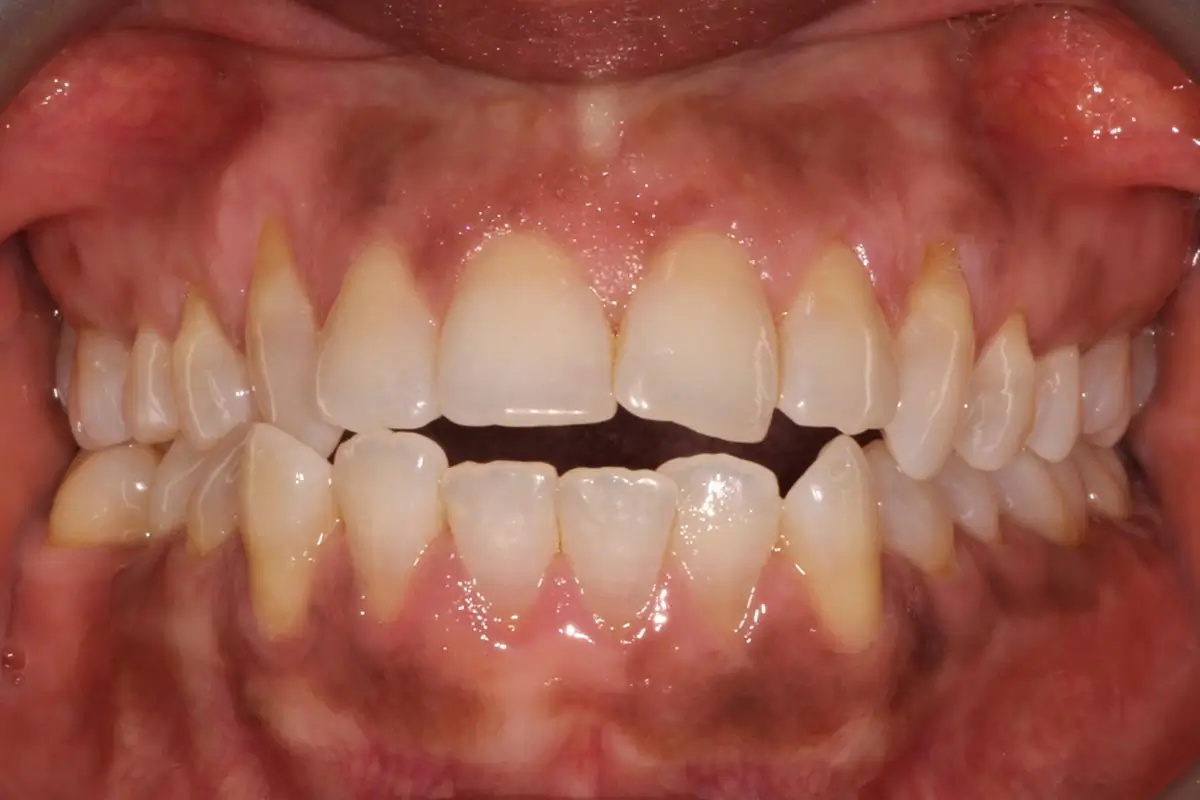 Before Intraoral Centre Tooth Photo