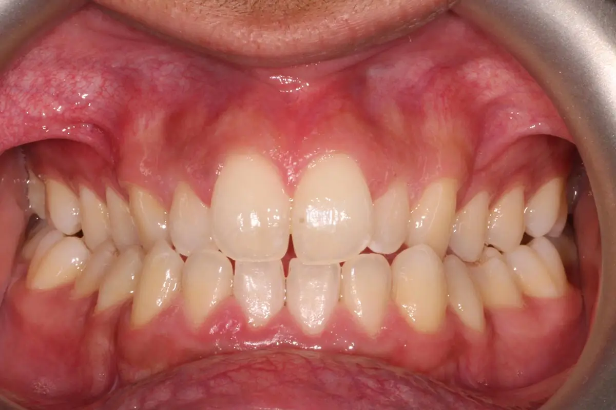 Before Intraoral Centre Tooth Photo