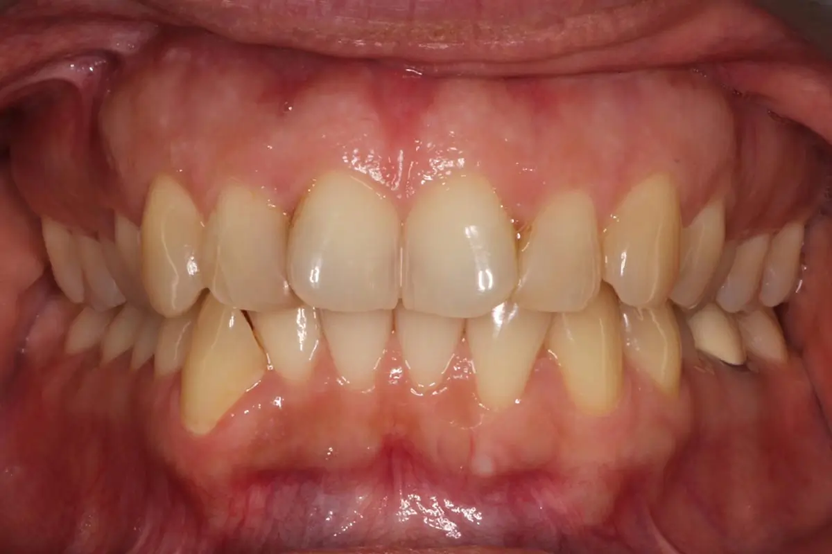 Before Intraoral Centre Tooth Photo