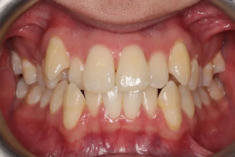 Before Intraoral Centre Tooth Photo