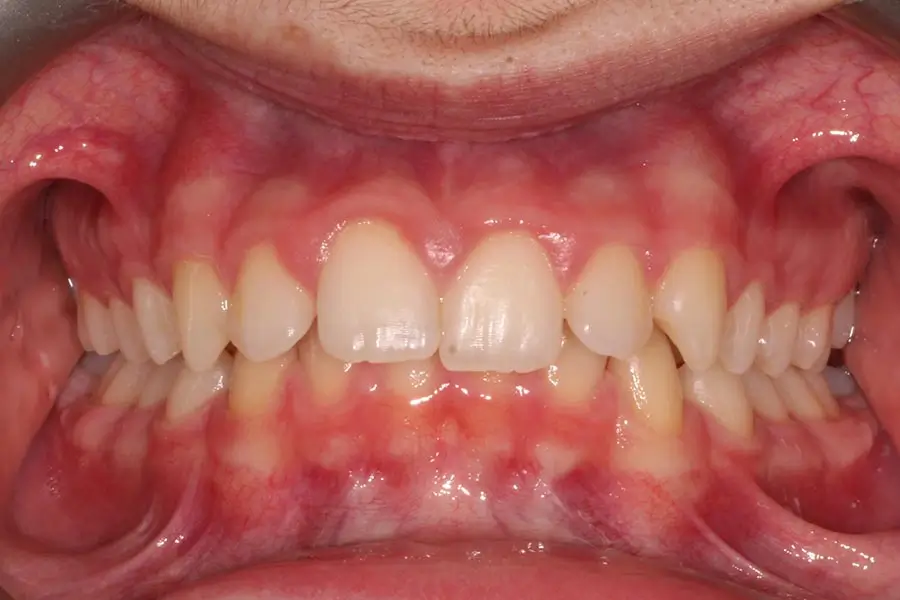 Before Intraoral Centre Tooth Photo