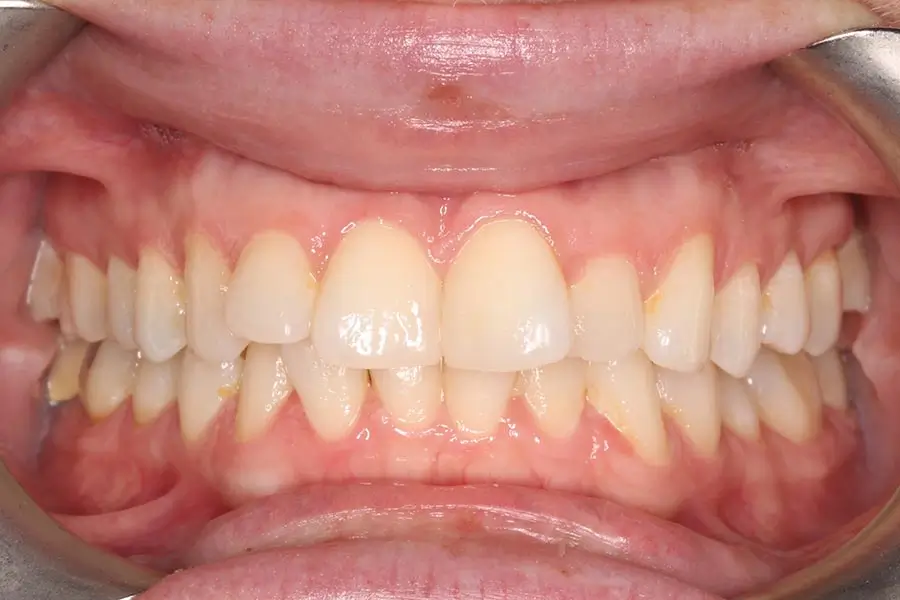 Before Intraoral Centre Tooth Photo