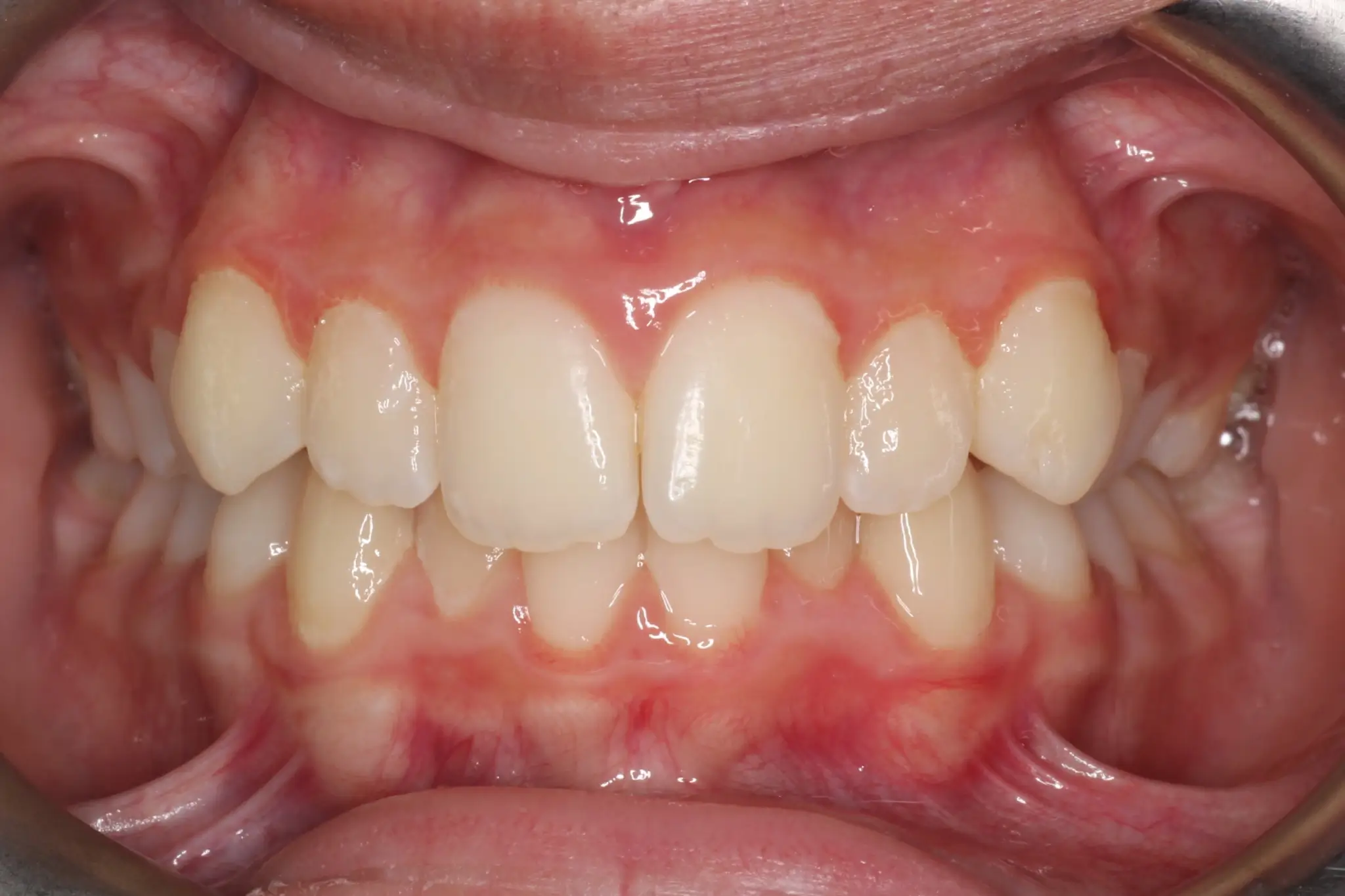 Before Intraoral Centre Tooth Photo