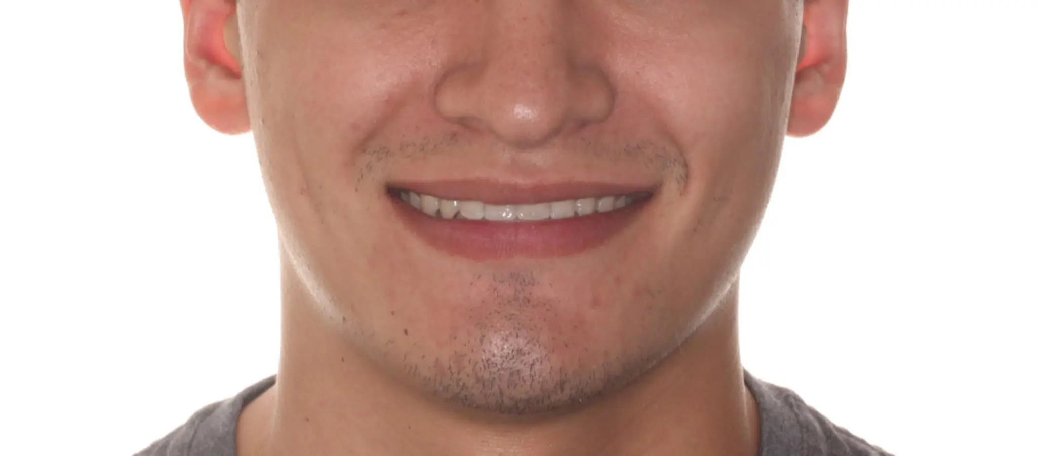 After Facial Smiling Photo