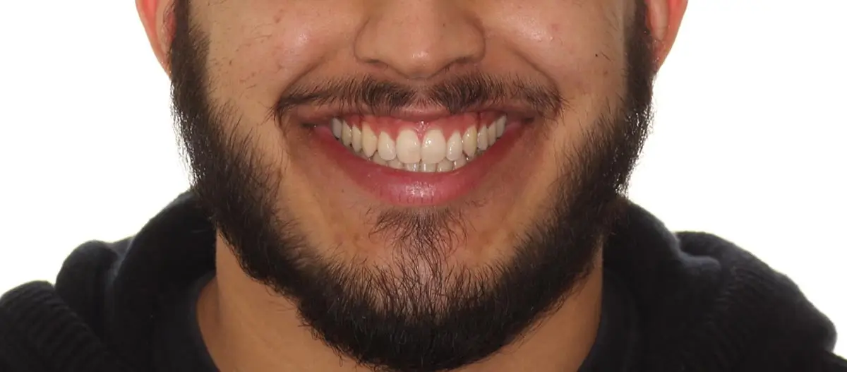 After Facial Smiling Photo