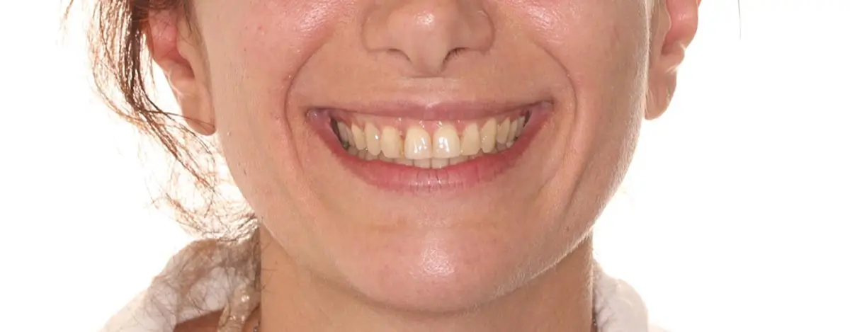 After Facial Smiling Photo