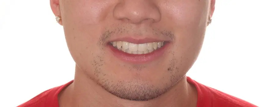 After Facial Smiling Photo