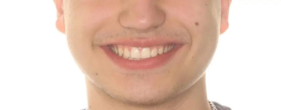After Facial Smiling Photo