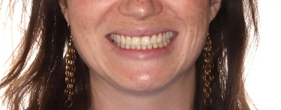 After Facial Smiling Photo