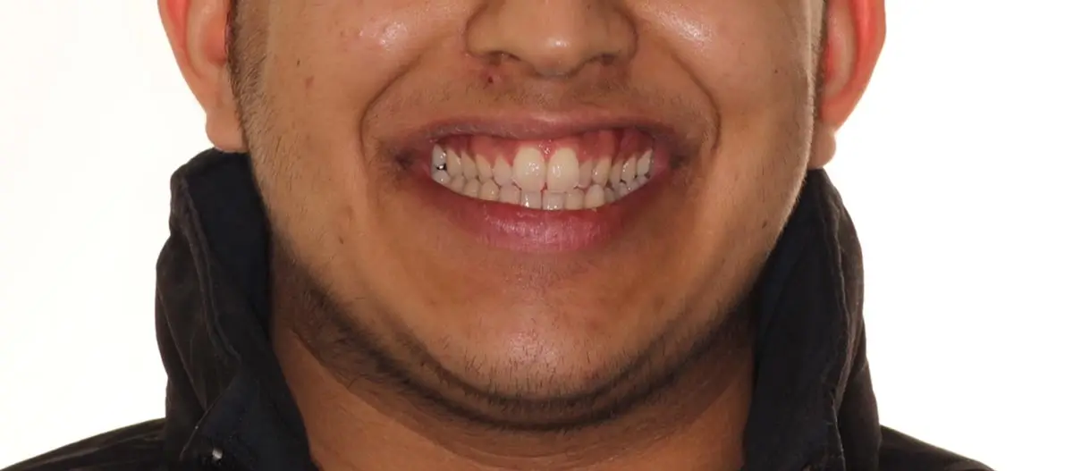 Before Facial Smiling Photo