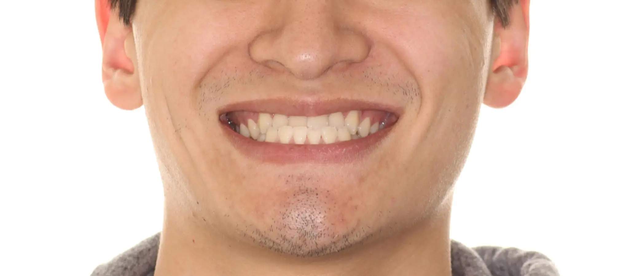 Before Facial Smiling Photo