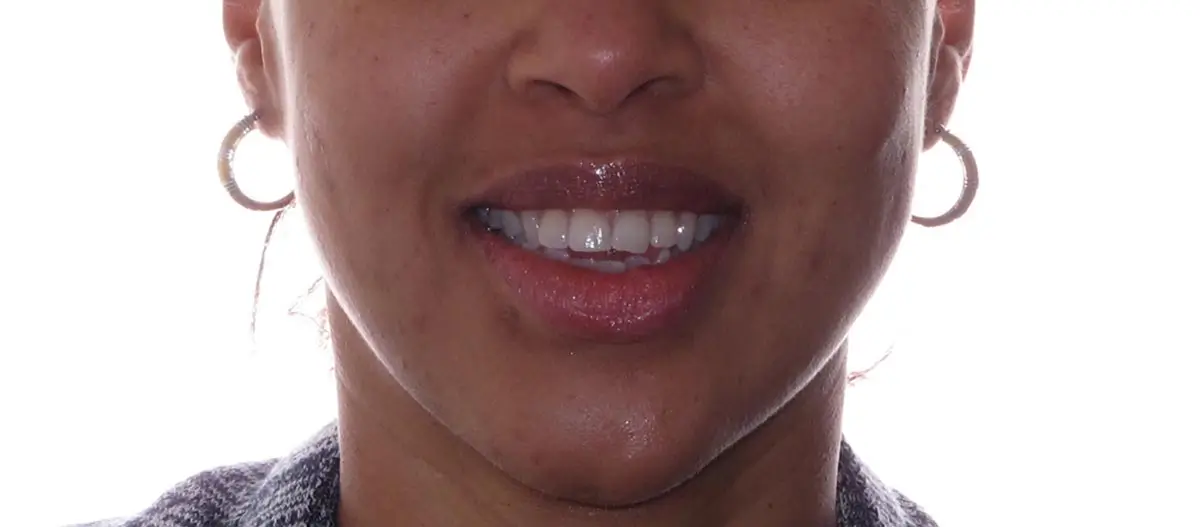 Before Facial Smiling Photo