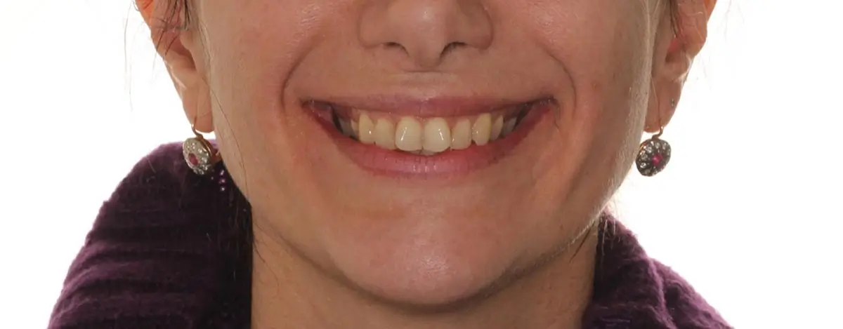 Before Facial Smiling Photo