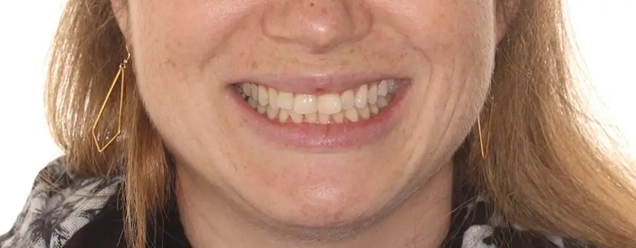 Before Facial Smiling Photo