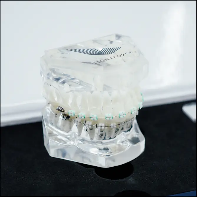 benefits-of-lightforcetm-braces-time benefits-of-lightforcetm-braces-time