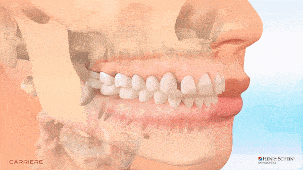 carriere-appliances-with-aligners