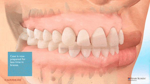 carriere-appliances-with-braces