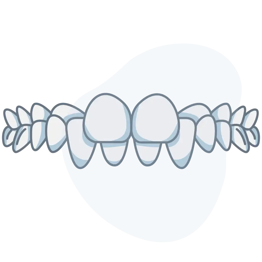 crossbite-back-teeth crossbite-back-teeth