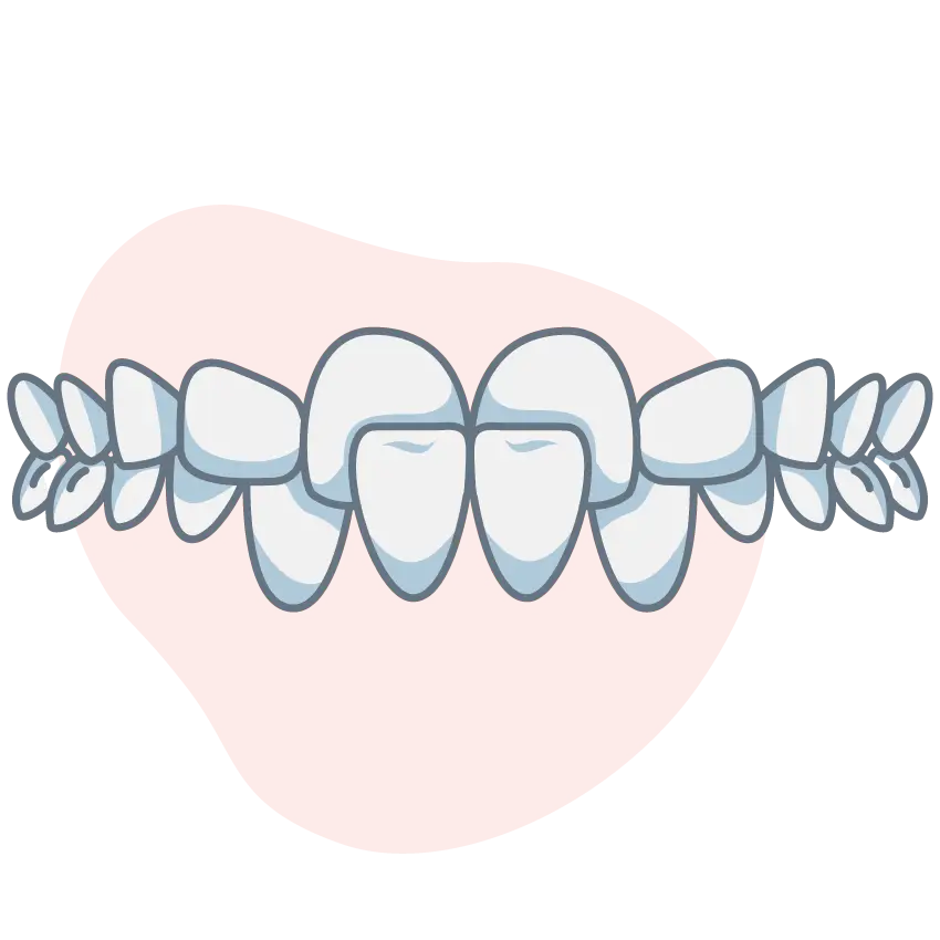crossbite-front-teeth crossbite-front-teeth
