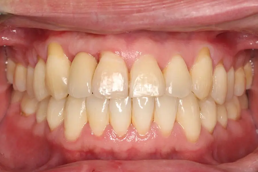 After Intraoral Centre Tooth Photo