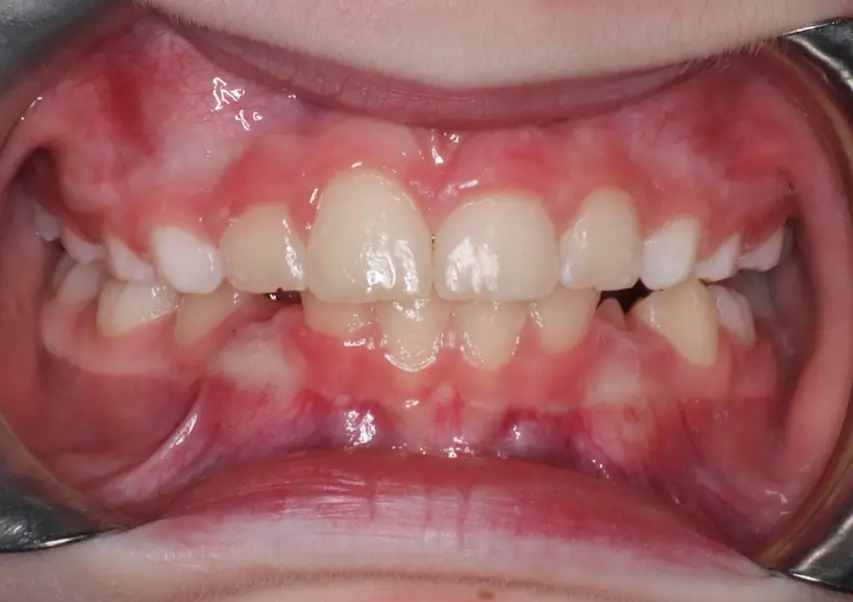 After Intraoral Centre Tooth Photo