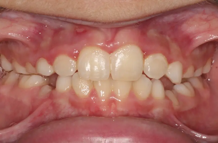 After Intraoral Centre Tooth Photo