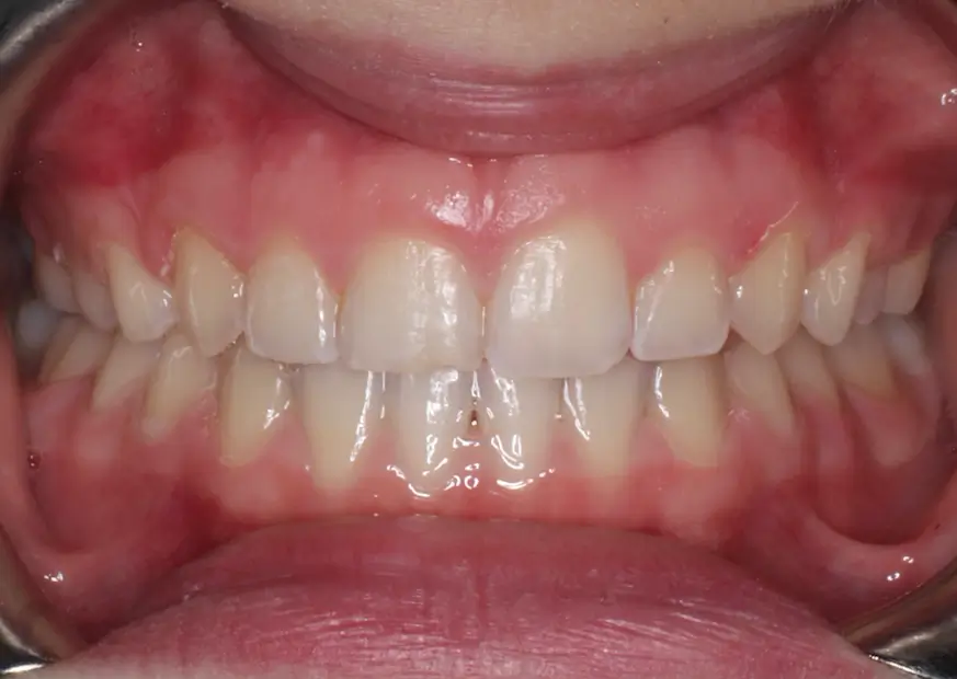 After Intraoral Centre Tooth Photo
