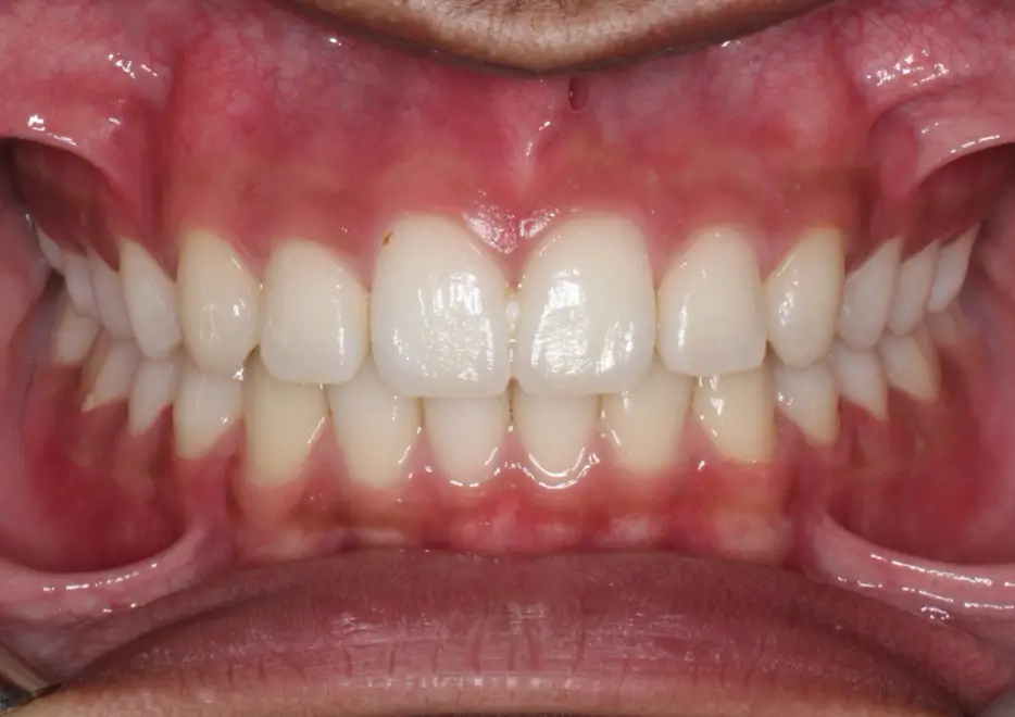 After Intraoral Centre Tooth Photo