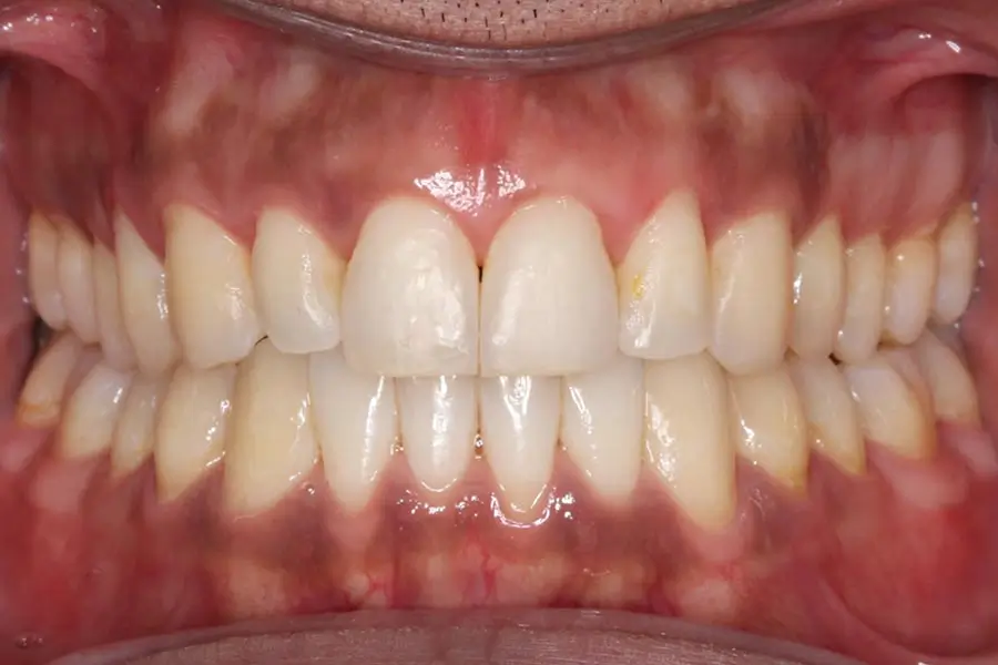 After Intraoral Centre Tooth Photo