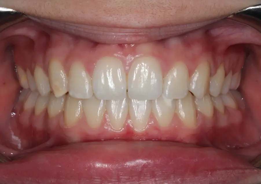 After Intraoral Centre Tooth Photo