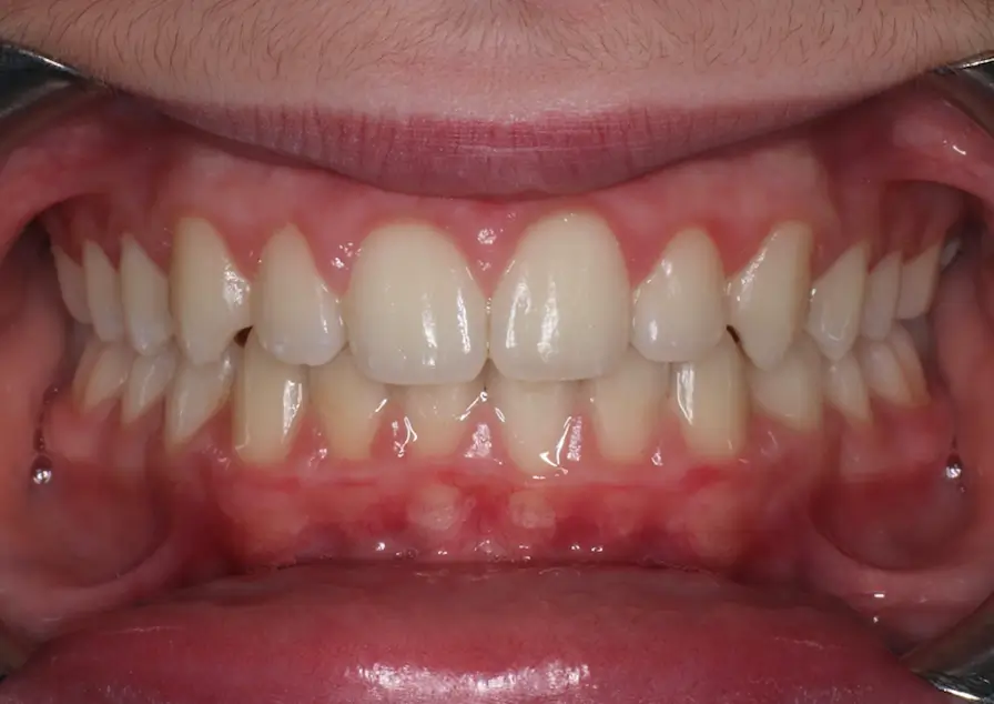 After Intraoral Centre Tooth Photo
