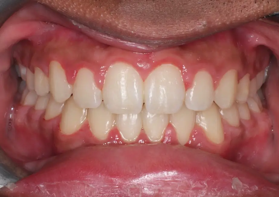 After Intraoral Centre Tooth Photo