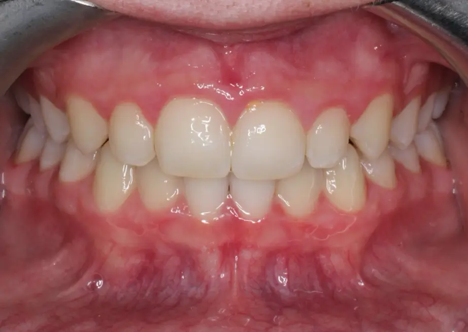 After Intraoral Centre Tooth Photo